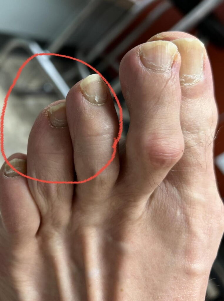 Overlapping toes caused by contracture and biomechanical instability