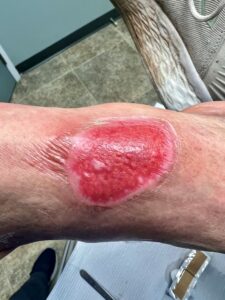 thermal burn to the skin on the top of the foot