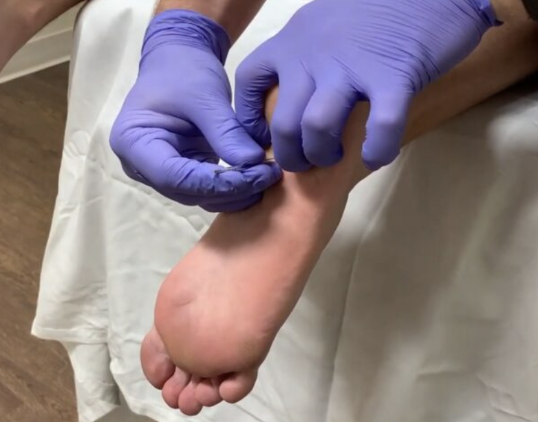 image of dry needling being applied to a plantar heel area