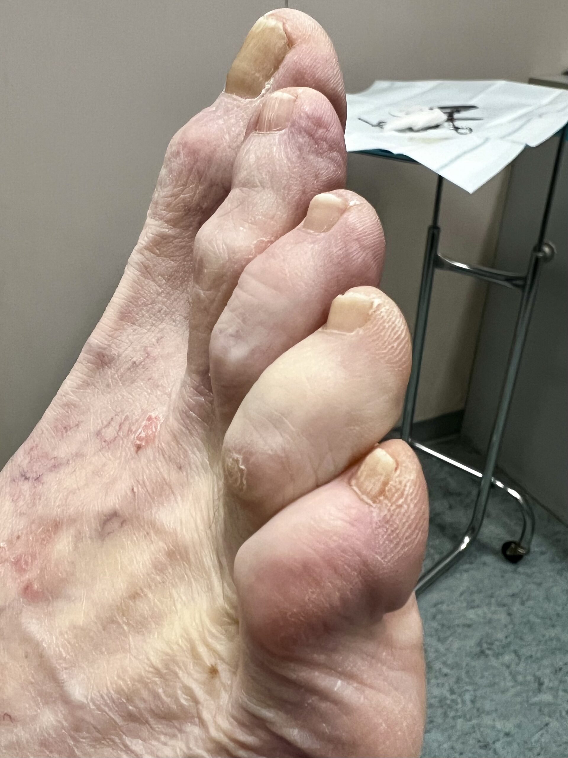 flexible toe deformities can be corrected painlessly and quickly
