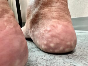fibro-fatty heel pad at the edge of the heel